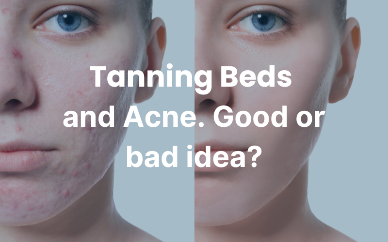 tanning bed and acne. does it help